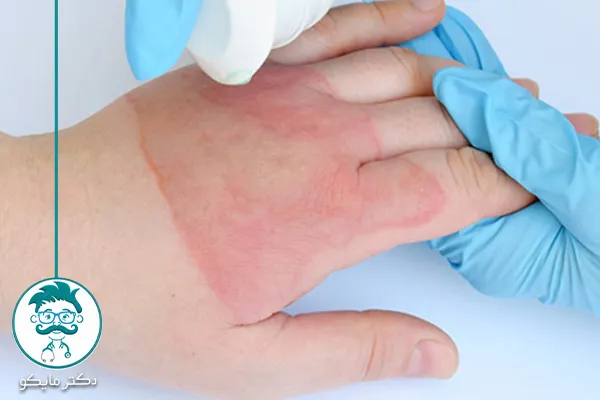 درمان  سوختگی با بخار