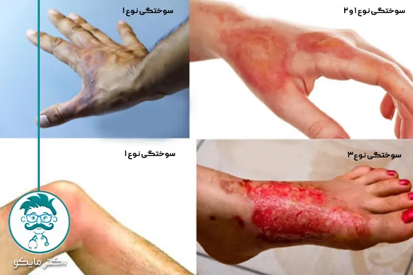 درمان سوختگی