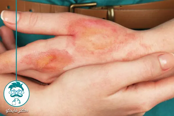 درمان سوختگی با آب جوش