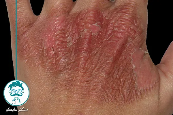 برای سوختگی چی خوبه؟