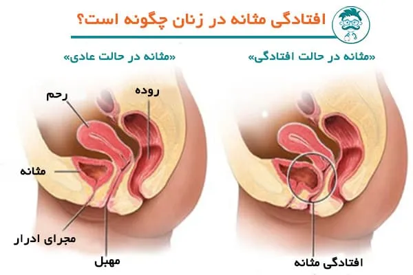 درمان خانگی افتادگی مثانه