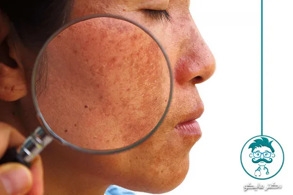 علت لکه های قهوه‌ای روی پوست بدن