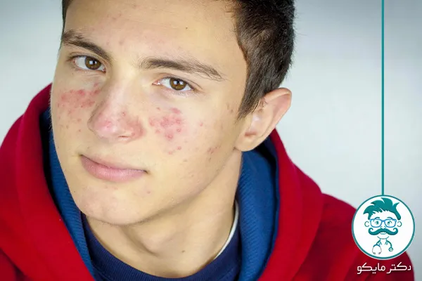 فوق تخصص پوست برای لک صورت