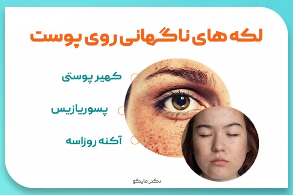 لکه های سفید روی پوست کودکان