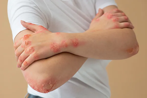اگزما پوستی چیست؟ عکس انواع اگزما، درمان فوری اگزما دست، صورت و… + بهترین پماد برای اگزمای پوستی