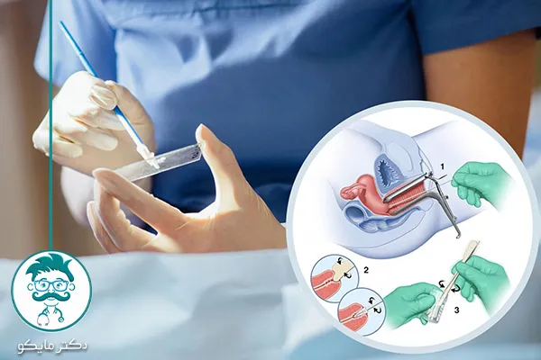 آزمایش پاپ اسمیر چگونه انجام می‌شود؟