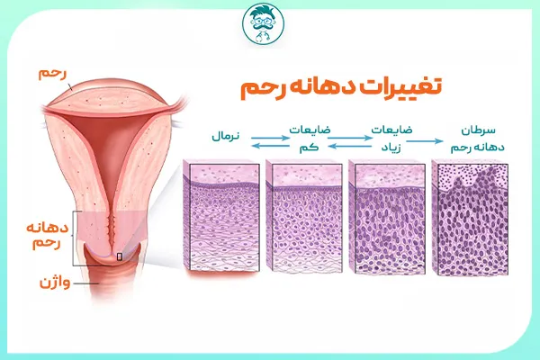 زمان انجام تست پاپ اسمیر و نتیجه ی آن