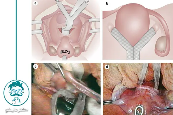 عوارض جراحی افتادگی رحم