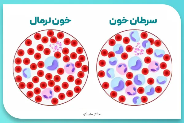 آیا سرطان خون درمان دارد؟
