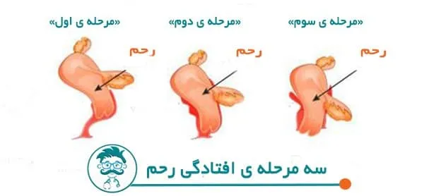آیا افتادگی رحم مانع بارداری و یا باعث سقط جنین می شود؟