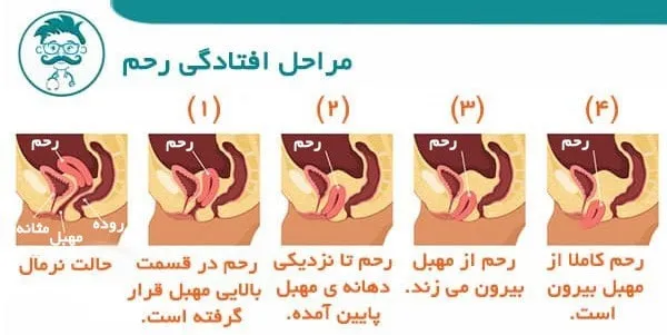 مراحل افتادگی رحم چگونه است؟ 
