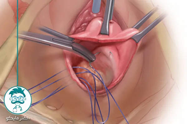 مراقبت بعد از عمل افتادگی رحم