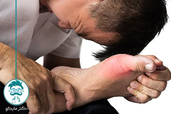 درمان خانگی نقرس