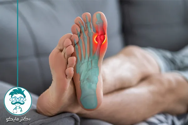 جلوگیری از نقرس