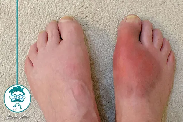 غذاهای مضر برای نقرس