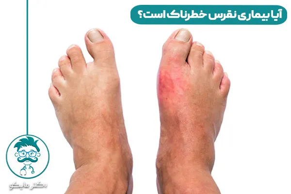 نقرس چیست و راه درمان آن 