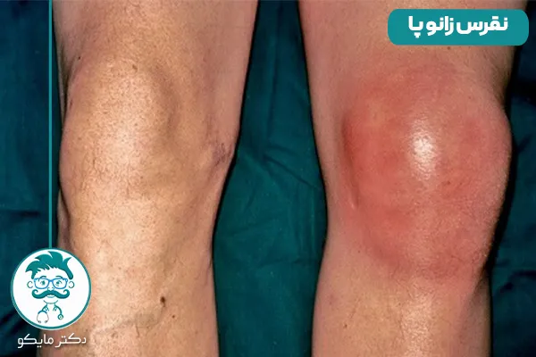 علائم نقرس زانو