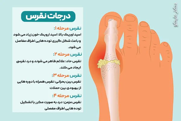 درجات و مراحل نقرس