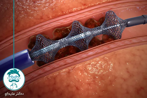 خطر آمبولی بعد از عمل لیپوماتیک