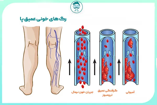 آمبولی چربی لیپوساکشن