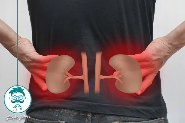 دفع سنگ کلیه از مثانه