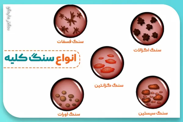 درمان سنگ کلیه های مختلف