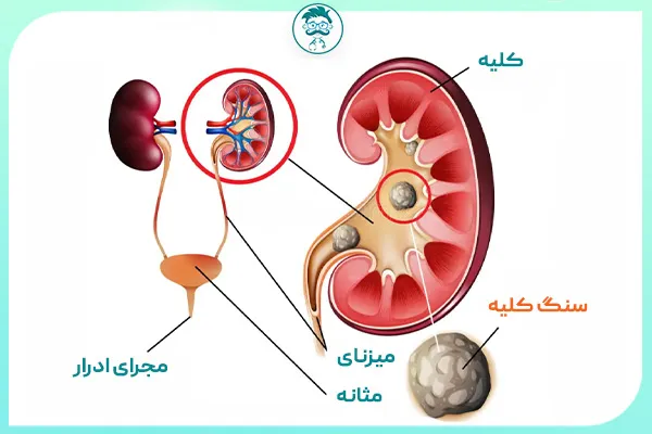 سنگ کلیه چیست؟