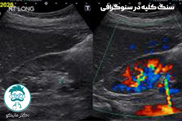 سنگ کلیه در سونوگرافی