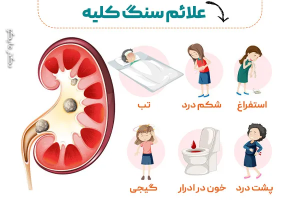 علائم انواع سنگ کلیه