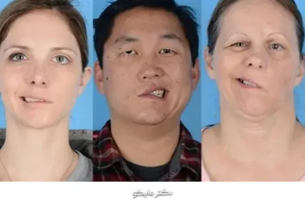 پیشگیری از فلج بلز