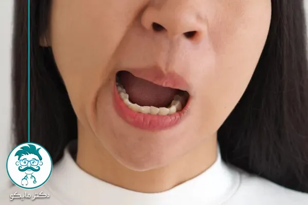 درمان قطعی فلج بلز با طب سنتی