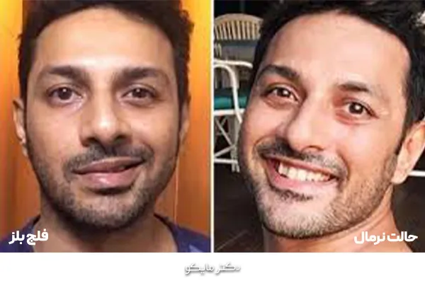 فلج بل چقدر طول می‌کشد؟