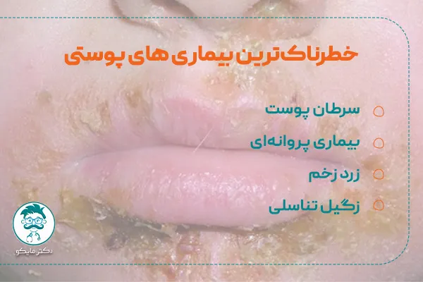 خطرناک ترین بیماری های پوستی