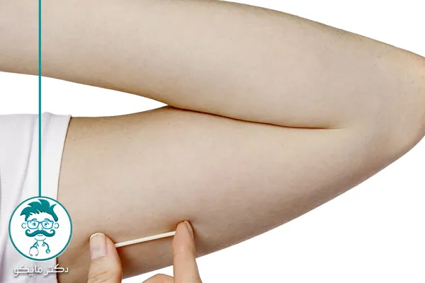 ایمپلنت ضد بارداری چیست؟