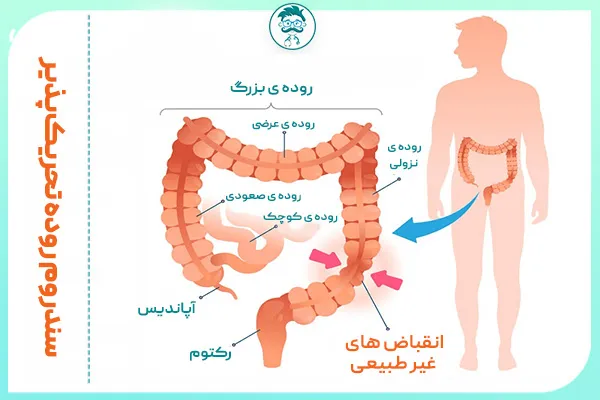 از کجا بفهمیم سندروم روده تحریک‌پذیر داریم؟
