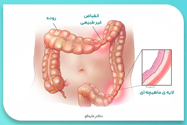 علت سندروم روده تحریک پذیر
