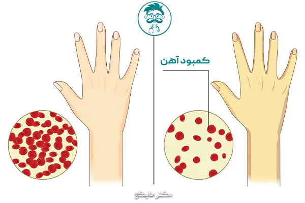 آیا فقر آهن خطرناک است؟