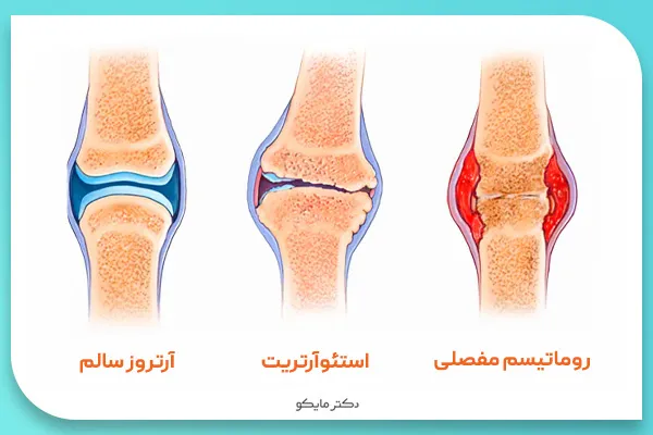 استئوآرتریت چیست؟