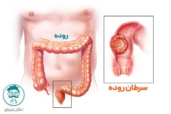 داروهای شیمی درمانی سرطان روده