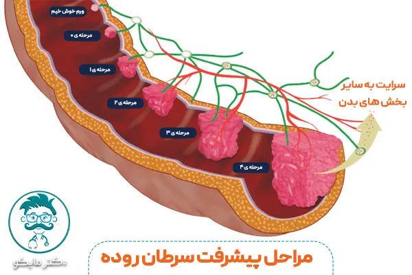مراحل سرطان روده کولون