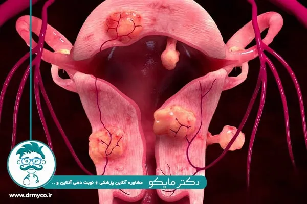 فیبروئید رحم و نازایی زنان