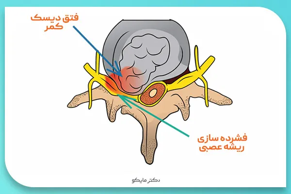 درمان فتق دیسک کمر بدون جراحی