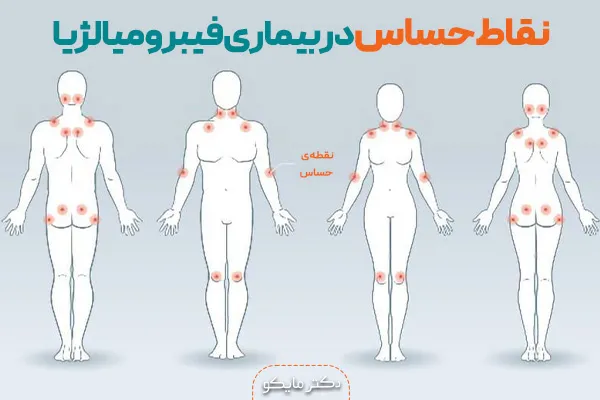 نقاط حساس بدن در فیبرومیالژیا