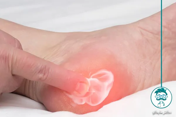 پیاز و سیر برای درمان خار پاشنه