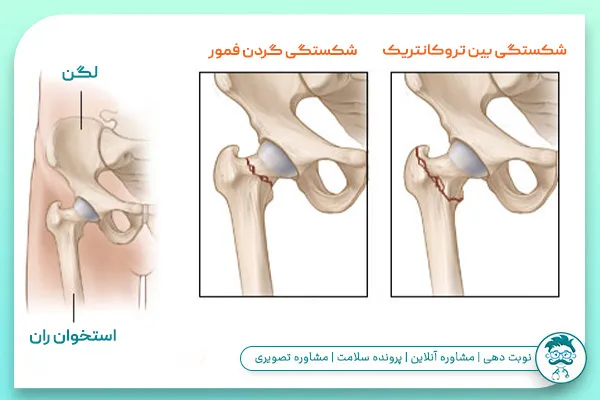 چرا شکستگی لگن کشنده است؟