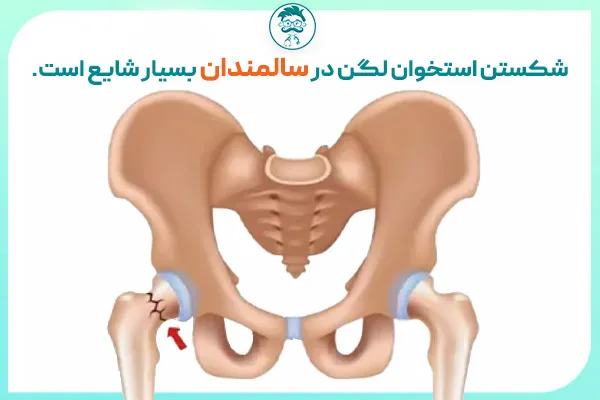 شکستگی لگن در سالمندان