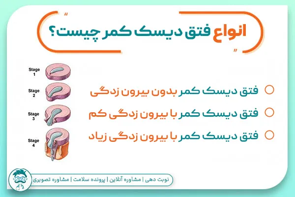 انواع بیرون زدگی دیسک کمر