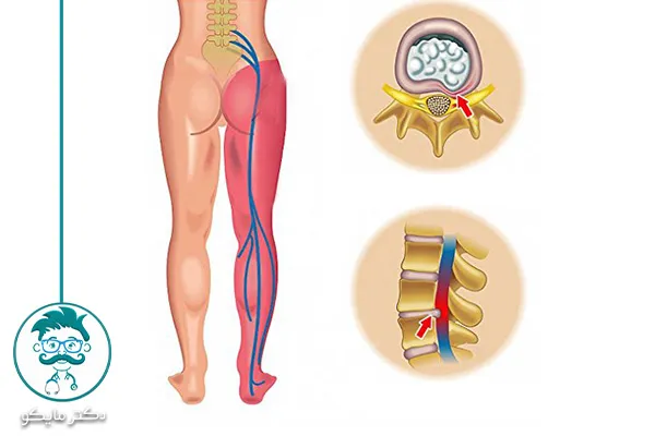 فتق دیسک کمر و سیاتیک
