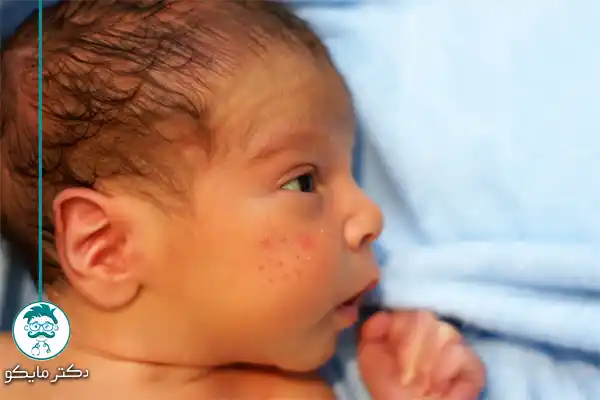 بیماری سوزاک در نوزادان