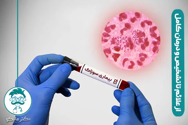 بیماری سوزاک